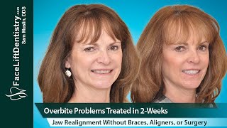 Overbite Problems Treated Jaw and Bite Realignment Without Braces Aligners or Surgery [upl. by Balch]