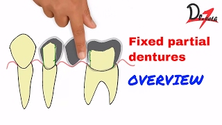 Fixed partial dentures  Overview HINDI [upl. by Nylodnew]