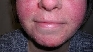 How to Treat Facial Eczema DermTVcom Epi 479 [upl. by Aianat]