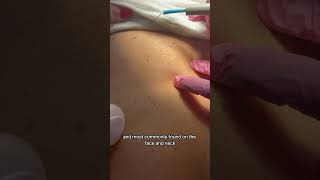 DPNs Dermatosis Papulosa Nigra spots removal skincare dermatology [upl. by Asilehs]