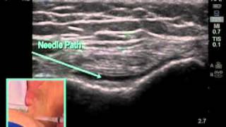 How to Ultrasound Guided Knee Injection Scanning Technique [upl. by Giordano]