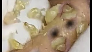 Deep blackhead extraction Cystic acne amp pimple popping 84 [upl. by Las245]