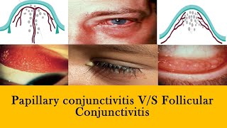 CONJUNCTIVITIS  papillae vs follicles and membranes [upl. by Bronk]