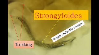 Strongyloidiasis cause and its pathogenesis Strongyloides under microscope [upl. by Devaney]