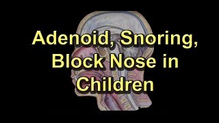 Adenoiditis Adenoid Surgery Snoring Block noseRunny nose in children [upl. by Shirlene]