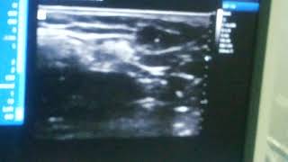 Ultrasound Guided Intercostobrachial Nerve Block [upl. by Thatch]