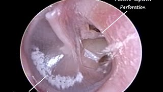 ENT Endoscopy  Chronic Sinusitis with Allergy causing left Eardrum peforation amp Tonsillitis [upl. by Rice]