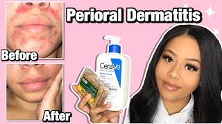 HOW I CLEARED MY PERIORAL DERMATITIS  Affordable Products [upl. by Perkins]