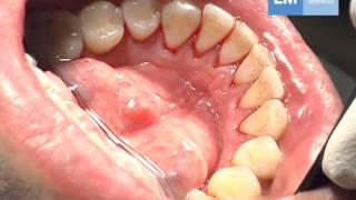 Periodontal treatment protocol [upl. by Heer]