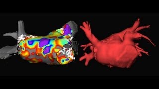 Catheter Ablation for Atrial Fibrillation [upl. by Moira]