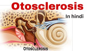 Otosclerosis nursing lecture in hindi  causetype symptoms treatmentsurgery  otosclerosis ent [upl. by Ecirbaf]