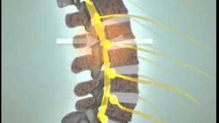 What is Spinal Stenosis  Lumbar Spinal Stenosis  DePuy Videos [upl. by Edbert]