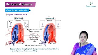 Pericardial Disease Hindi  Etiology Clinical Features Diagnosis Treatment and Complications [upl. by Agustin]