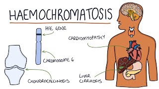 Understanding Haemochromatosis [upl. by Pilloff69]