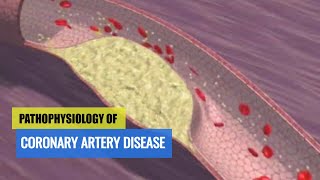 Pathophysiology of Coronary Artery Disease amp ACS Motion Animation [upl. by Chap819]