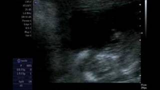 Our Pregnancy 12 weeks 5 days  Nuchal fold scan [upl. by Ambrose]