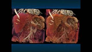 CT of Splenic Anomalies from Splenosis to Polysplenia Potential Pitfalls in Diagnosis  Part 1 [upl. by Theron]