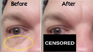 How Use Trichloroacetic Acid on Xanthelasma Spots Around Eyes at Home WARNING My BAD Experience TCA [upl. by Crain]