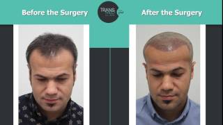 Transmed Clinic Hair Transplant Before and After [upl. by Llemej294]