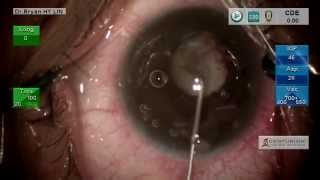 Complicated cataract surgery Phaco of intractable white cataract with posterior synechiae [upl. by Cyrilla192]