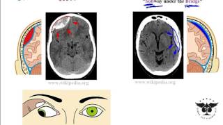 Hemorrhagic stroke epidural amp subdural hematoma  USMLE Step 1 [upl. by Nowtna]