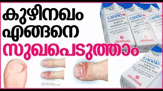 മൂന്ന് ദിവസം കൊണ്ട് കുഴി നഖം മാറ്റാം Toenail Fungus  Candid Lotion Malayalam Review [upl. by Selfridge]