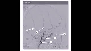 External Carotid Angiogram [upl. by Filia]