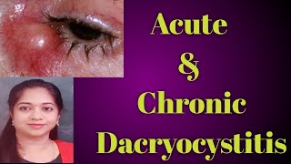 Dacryocystitis  Acute dacryocystitis Chronic Dacryocystitis Stages of Dcryocystitis Mucocele [upl. by Aettam581]