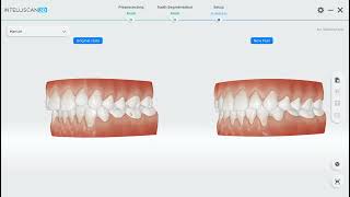 Intelliscan3D ConsulOS Feature  Ortho Simulation [upl. by Emalee]