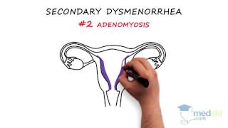 Obstetrics and Gynecology – Dysmenorrhea By Paul Davies MD [upl. by Eirtemed]