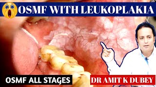 OSMF Greads। OSMF with LEUKOPLAKIA। its Treatment 😱🥴🥴 [upl. by Sim]