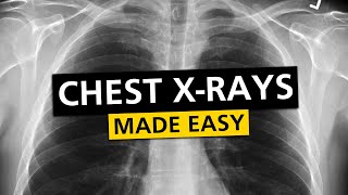 Chest X Rays CXR Made Easy  Learn in 10 Minutes [upl. by Sukramed]