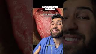 Why Do Some Tongues Look Like This health [upl. by Ibson]