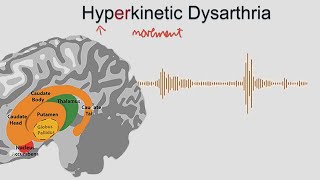 Hyperkinetic Dysarthria  samples and explanation [upl. by Bee]