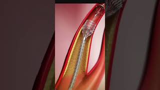 ANGIOPLASTY PROCEDURE ANIMATED [upl. by Martinic556]