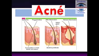 LAcné les causes hormonales sur le corps visage front nez dos formes sévère et légère 1ère Partie [upl. by Aidyn]