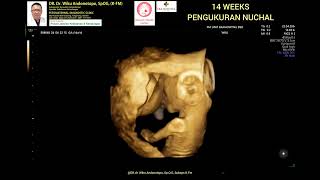 Pengukuran nuchal thickness 14 weeks [upl. by Eniarrol]