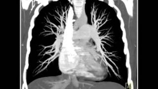 Lung Anatomy Pulmonary Embolism MIP [upl. by Cherice]