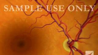 Eye Retinal Artery Damage [upl. by Cinimmod]