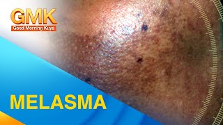 MELASMA Cause and Treatment Explained by Dermatologist [upl. by Atel]