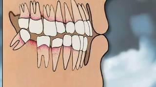 Dental Implants Pros amp Cons  YOU MUST SEE IT [upl. by On]