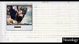 Postconvulsive central apnea as a biomarker for sudden unexpected death in epilepsy SUDEP 1 [upl. by Aelaza]