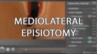 Trailer  Chapter on Episiotomy [upl. by Bunow]