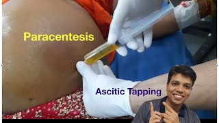 Ascitic tapping [upl. by Nnayr672]