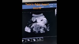 Twins fetal heart sound  heart beat twins pregnancy pregnancy obglife baby ultrasound [upl. by Estren941]