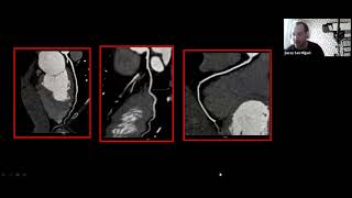 Clase 15  Angiotomografía en la enfermedad coronaria [upl. by Hakym]