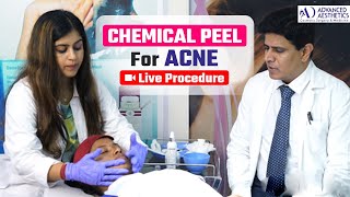 Chemical Peeling for Acne Scars  Live Procedure Step by Step  Glycolic Acid Mask  Dr Ashish [upl. by Aissirac]