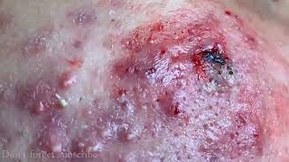 CYSTIC ACNE REMOVAL  Inflammatory Acne Acne Skin Treatment [upl. by Robbin]