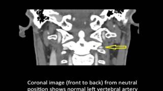 Vertebrobasilar Artery Syndrome  Bowhunters Syndrome  Colorado Spine Surgeon [upl. by Stagg]