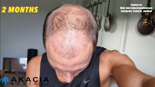 Hair Transplant Growth Timeline  the first 3 months [upl. by Iggy874]